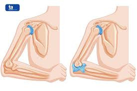 Chẩn đoán và điều trị trật khớp cấp tính